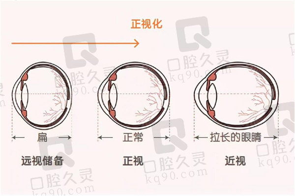 远视加散光怎么治疗