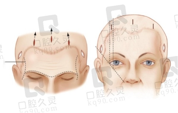 额头填充的常见方法