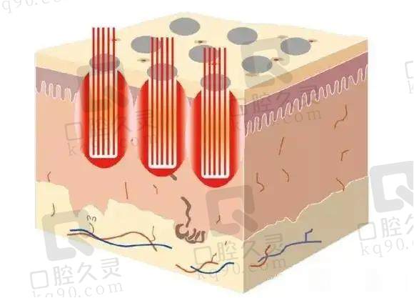 IPL（强脉冲光）治疗干眼症的原理