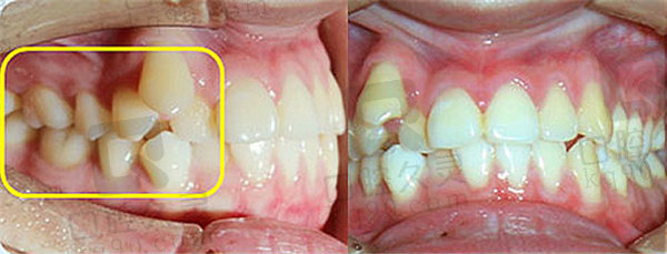 广州德伦口腔医院矫正牙齿前的图