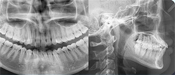广州德伦口腔医院矫正牙齿后的图