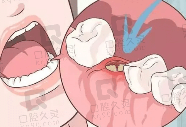 拔智齿后疼痛会持续多久