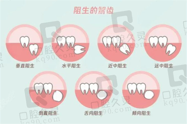 阻生智齿龈瓣整形术是什么意思