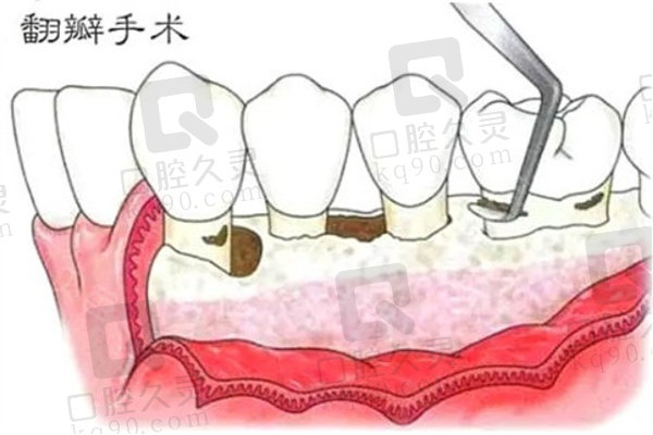 牙龈翻瓣术是什么意思