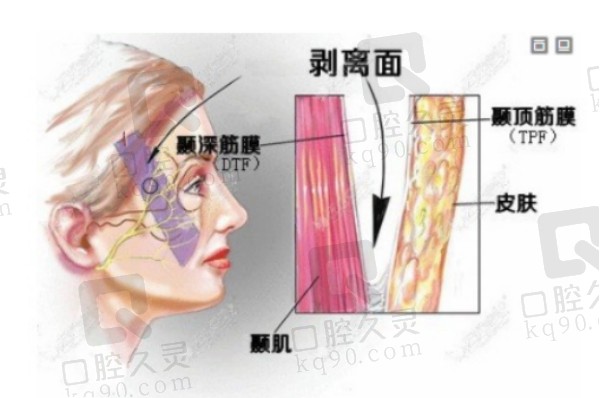 筋膜折叠术和筋膜悬吊哪个好