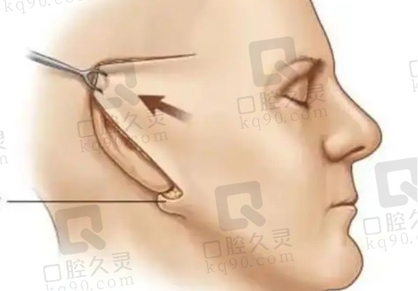 筋膜折叠术和筋膜悬吊成效比对