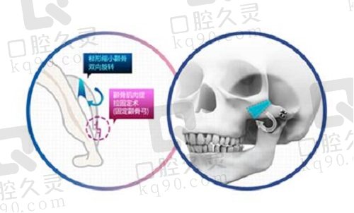 北京圣嘉新张笑天颧骨内推多少钱？