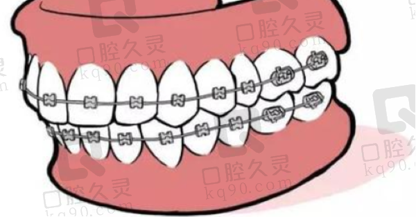 玉溪牙博仕口腔牙齿矫正多少钱