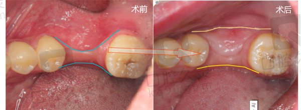 角化龈移植病例