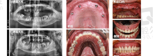 全口/半口种植病例