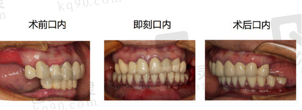 下半口即刻种植病例