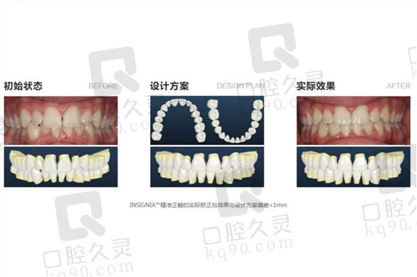 美国INSIGNIA数字化矫正和隐适美的牙套哪个好