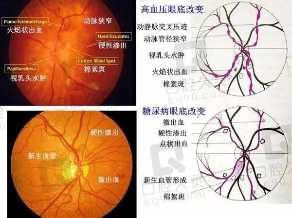眼睛模糊有黑点和乌云状物的预防和日常护理