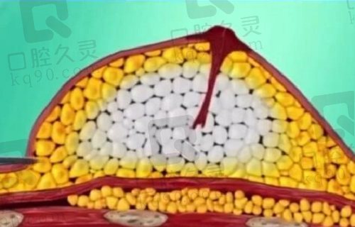 冯斌专注脂肪移植32年在线预约