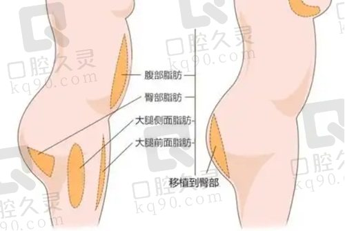 冯斌专注脂肪移植32年在线预约