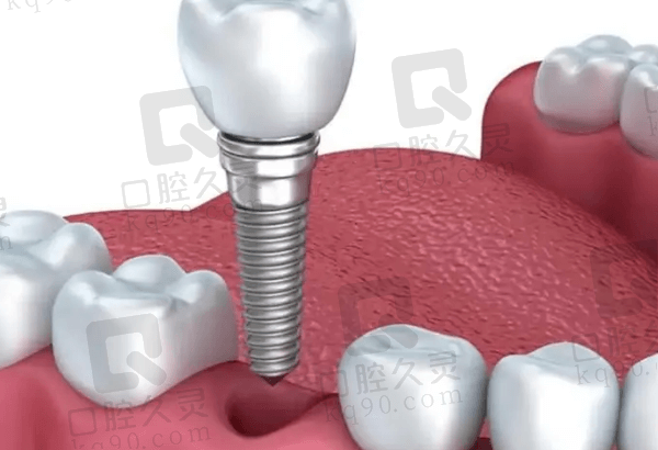 大连齿医生口腔种植牙怎么样