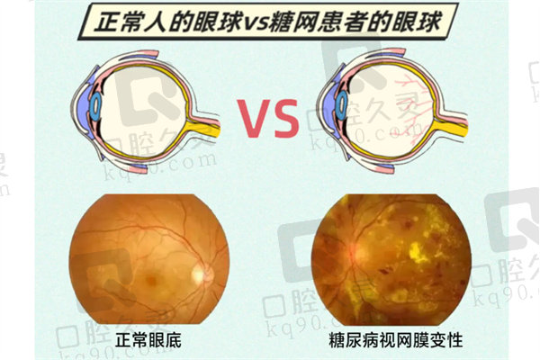 糖尿病视网膜病变的主要原因