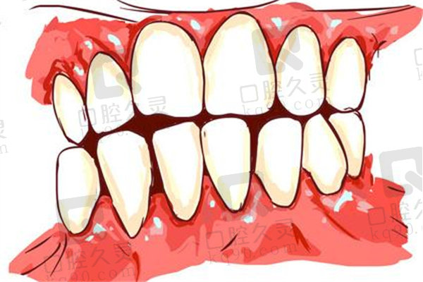 牙龈萎缩牙根暴露又酸又疼怎么办？