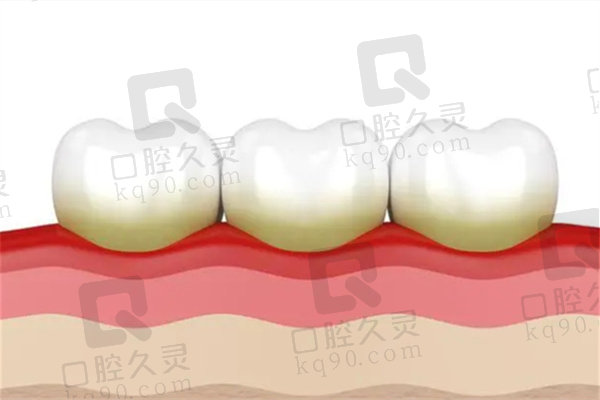 牙龈萎缩牙根暴露又酸又疼怎么办？