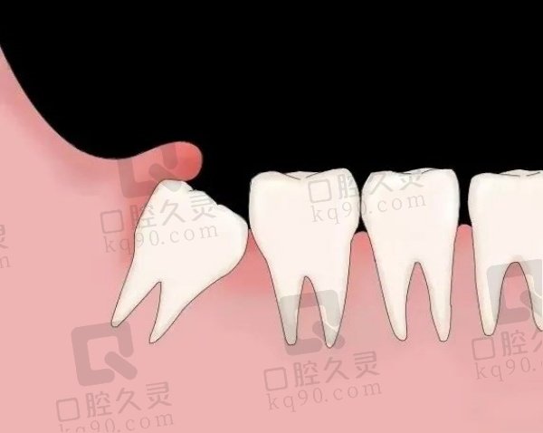 洛阳牙大夫口腔拔智齿怎么样