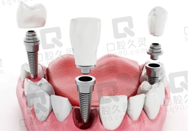 重庆龙山团圆口腔医院种植牙价格表