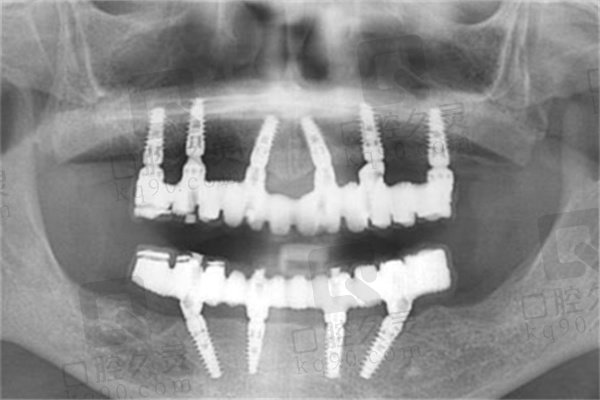 全口缺牙的理想修复方式