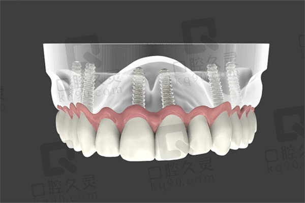 全口缺牙的理想修复方式