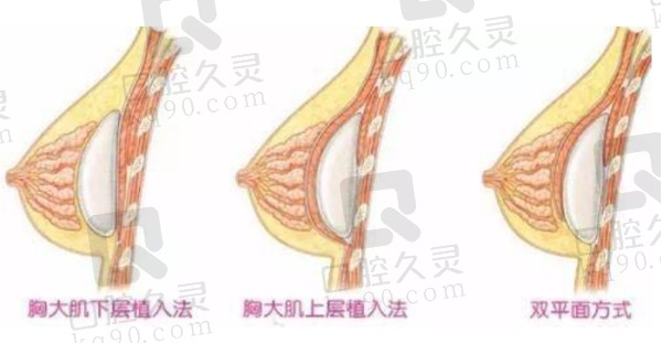 德国宝俪假体隆胸优点