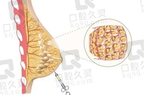 北京英煌陈伟医生自体脂肪丰胸