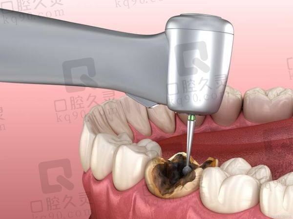 南宁牙博士口腔医院前磨牙根管治疗多少钱