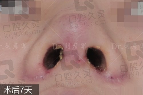 刘彦军做鼻子价格价格7w起