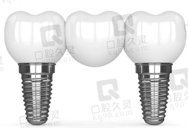 廊坊圣洁口腔医院种植牙怎么样
