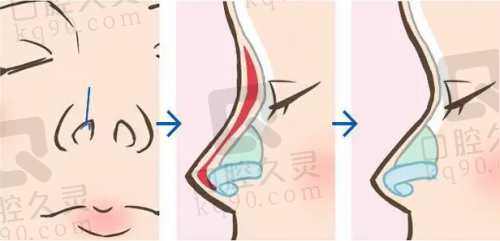 南京艺星鼻部整形手术价格表
