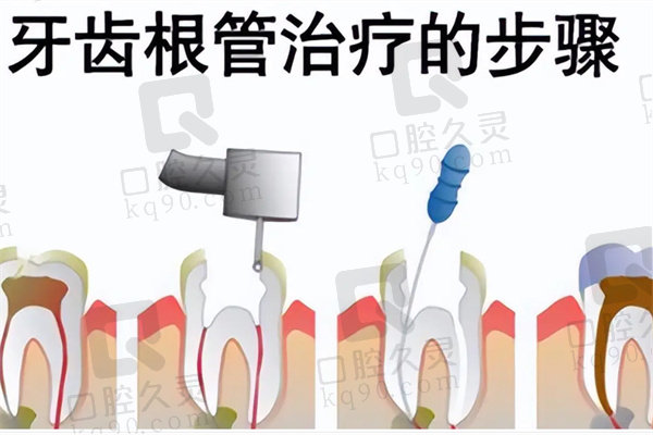 根管治疗的具体流程详解