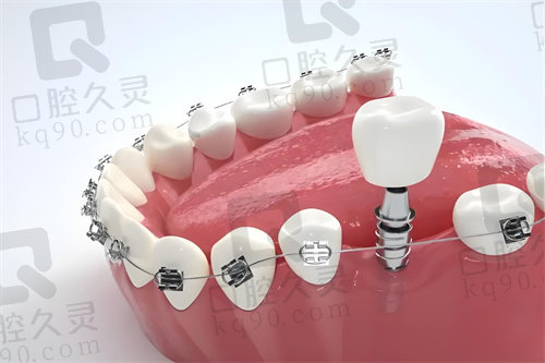 牙齿矫正术前术后注意事项