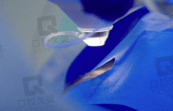 南通文慈眼科医院找张建做全飞秒真的值