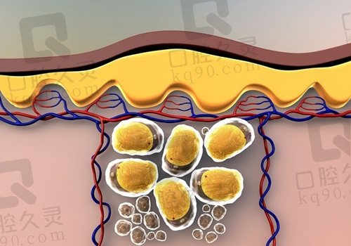北京清木马梅生医生脂肪移植