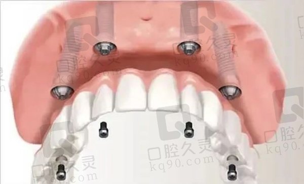 芜湖伊莱美口腔医院半口种植牙价格