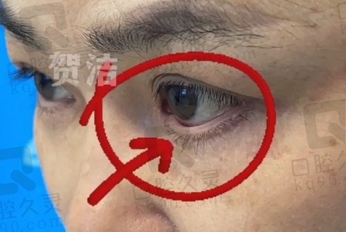 郑州东方整形贺洁院长睑外翻怎么样？