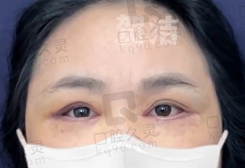 郑州东方整形贺洁院长睑外翻怎么样？
