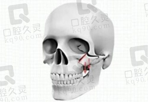 北京联合丽格何照华医生颧骨颧弓缩小