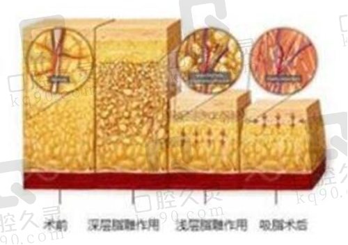 北京艺美王东医生面部吸脂