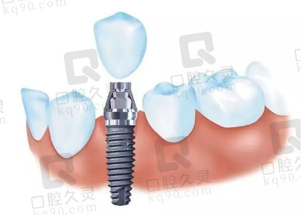 2025赣州维乐口腔医院种植牙价格表