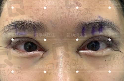 郑州东方贺焕焕医生双眼皮