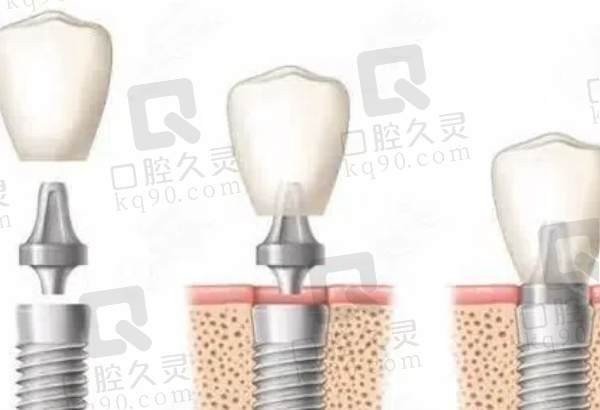 宽城李永全口腔门诊部李永全医生种植牙怎么样