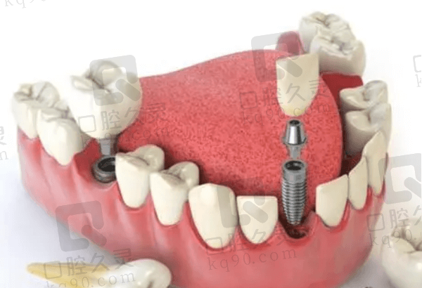 益阳牙科医院种植牙价格