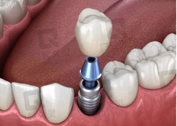 郑州马泷口腔口腔医院种植牙贵不贵