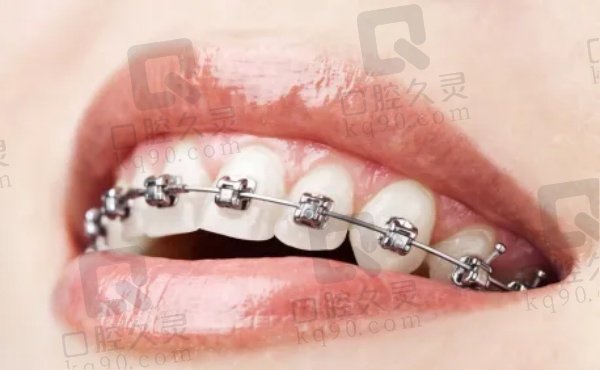 自锁托槽矫正的好处是什么