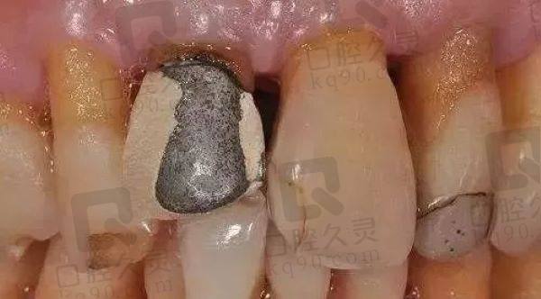 泉州美特尔口腔钴铬烤瓷牙多少钱