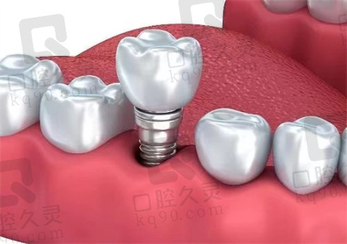  安徽淮北 口腔医院韩 式微创种植牙技术优势